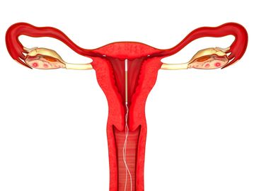 Liletta, Mirena, Paraguard IUD (intrauterine device). Contraception, menorrhagia (heavy bleeding).