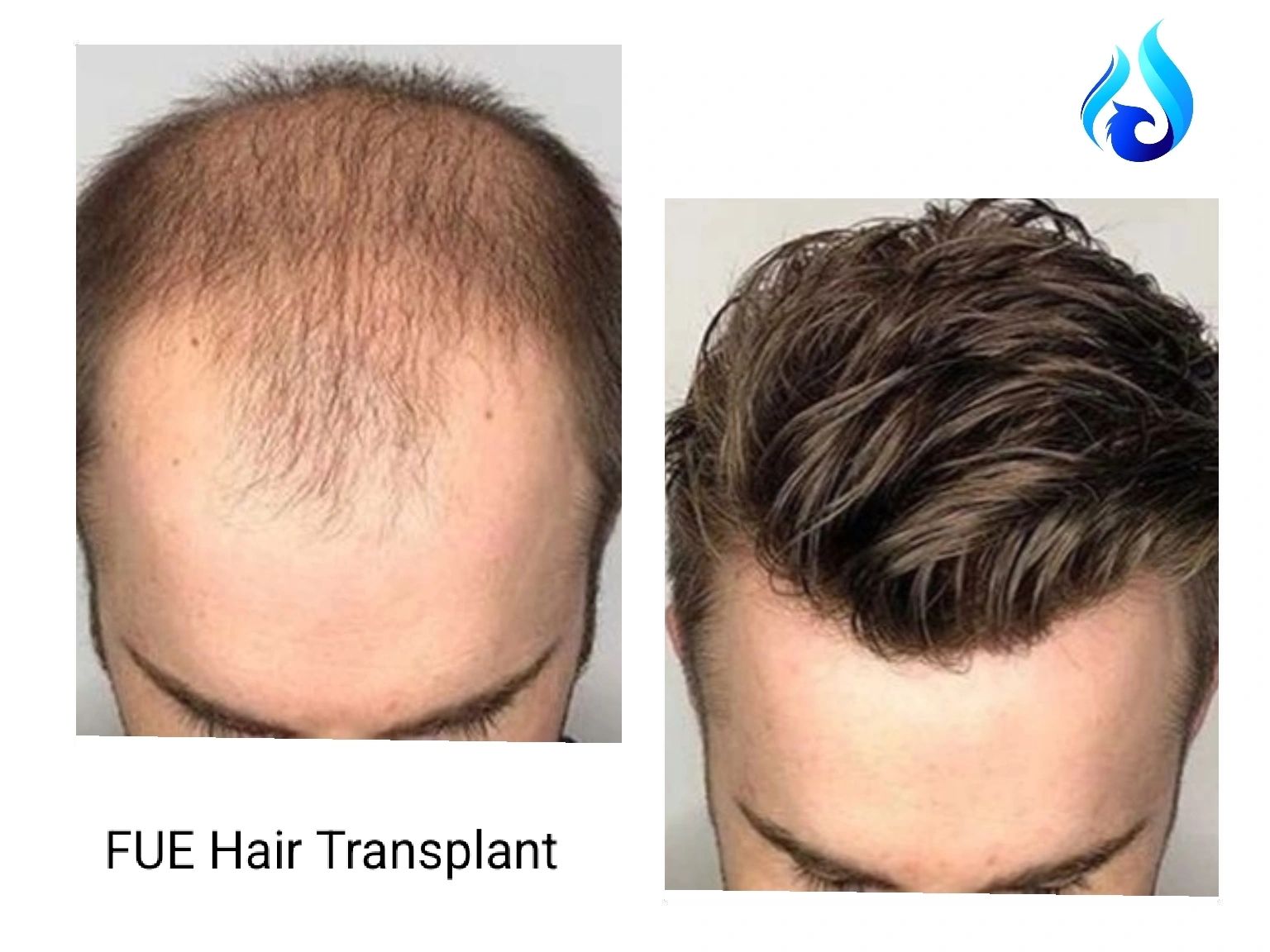 Before and after FUE hair transplant showing significant hair restoration.