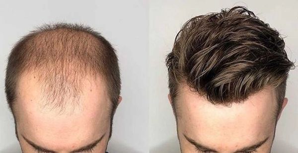 FUE 4500 graft Hair Transplant 