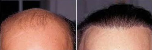 FUE Hair Transplant before and after photos 