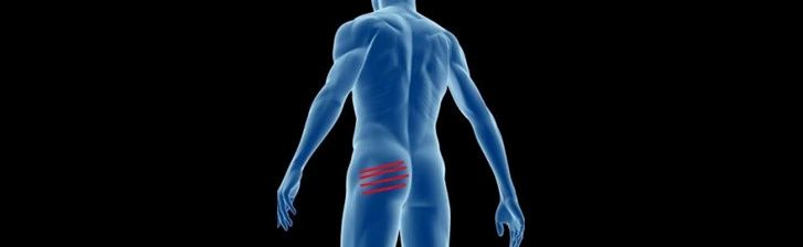 Piriformis Syndrome Sometimes Called Sciatica