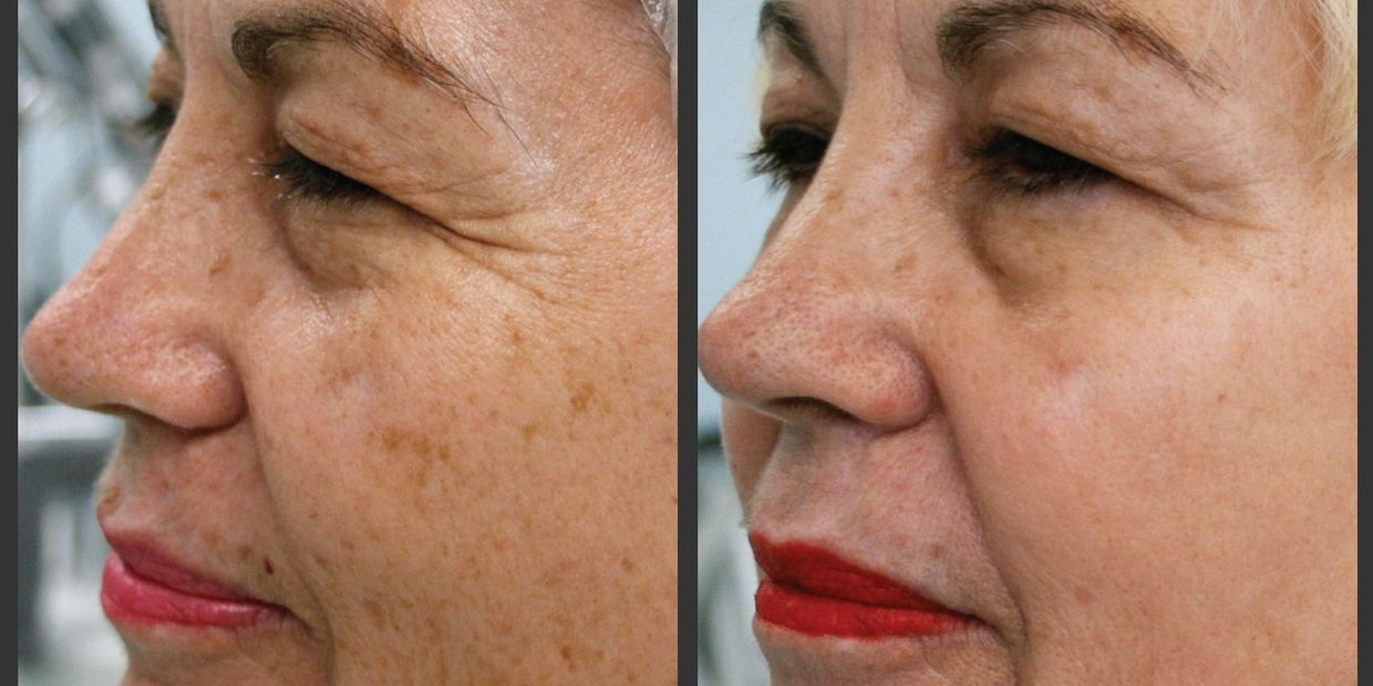 Photorejuvenation/IPL