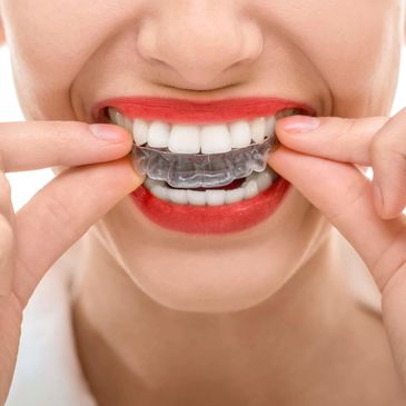 Person inserting a clear dental aligner on teeth.