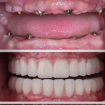 Before and after dental implants with full dentures.
