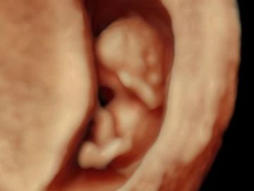 10 weeks gestation HD LIVE ultrasound