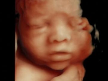 30 weeks gestation HD LIVE ultrasound