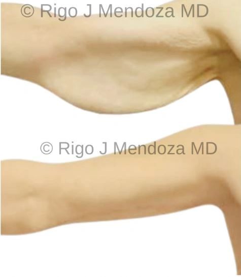 Brachioplasty aka Arm Lift