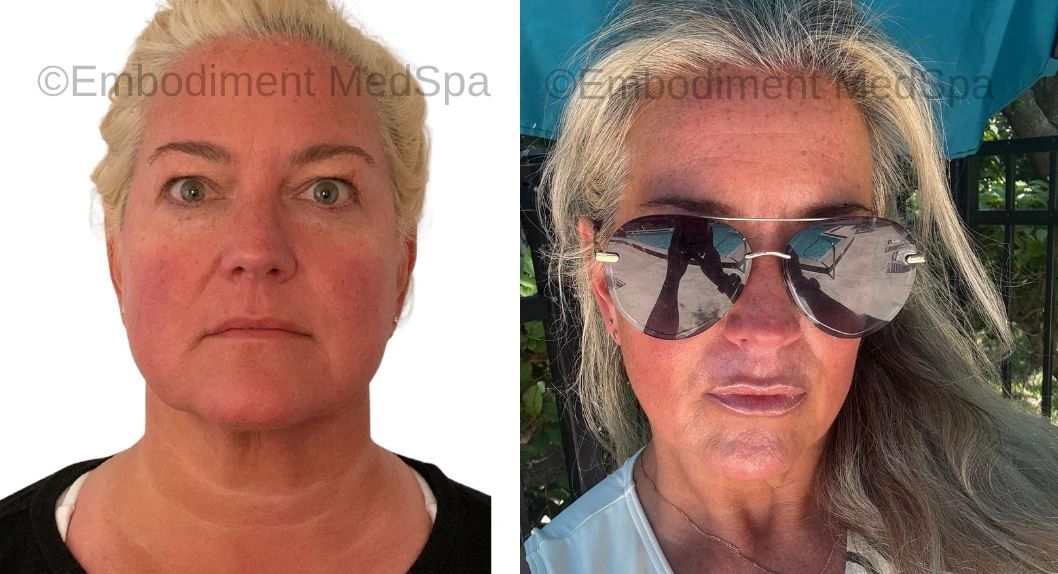 One syringe of Restylane Kysse to this patient's lips and marionette lines.