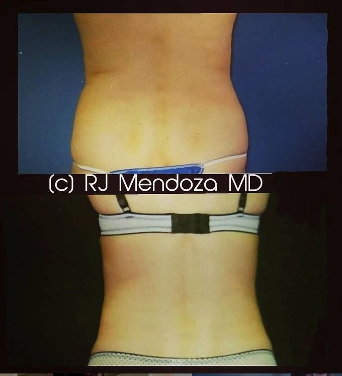 Liposuction of lower back.
