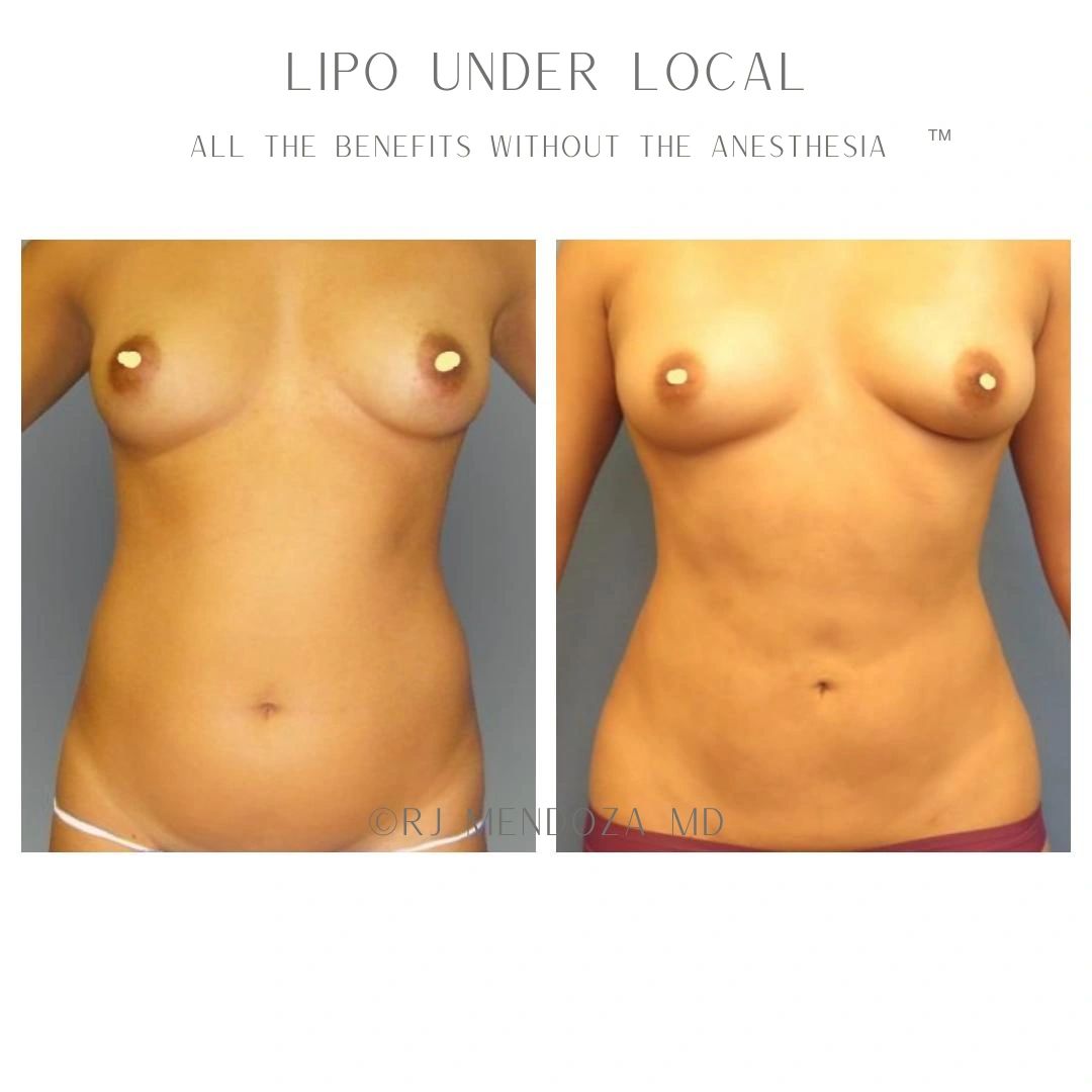 Liposuction with Renuvion to Upper and Lower Abdomen.
