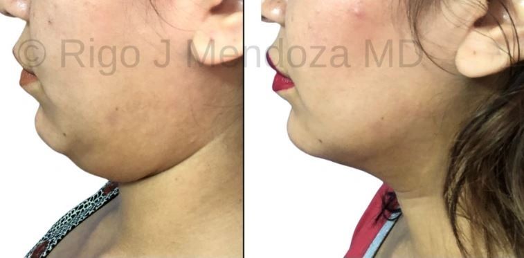 Liposuction with Renuvion of the Chin