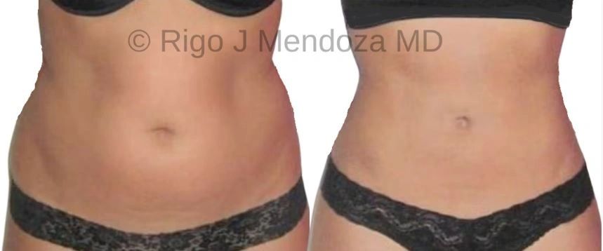 Liposuction to the Upper and Lower Abdomen and Waist