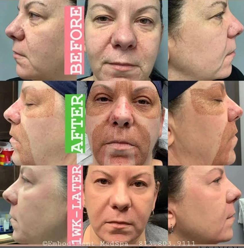Plasma Pen of the Upper and Lower Eyelids, Crows Feet , Glabellar and Mouth.