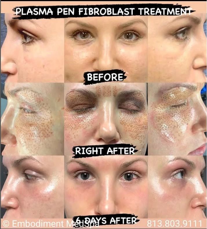 Plasma Pen of the Upper and Lower Eyelids, Crows Feet and Glabellar.