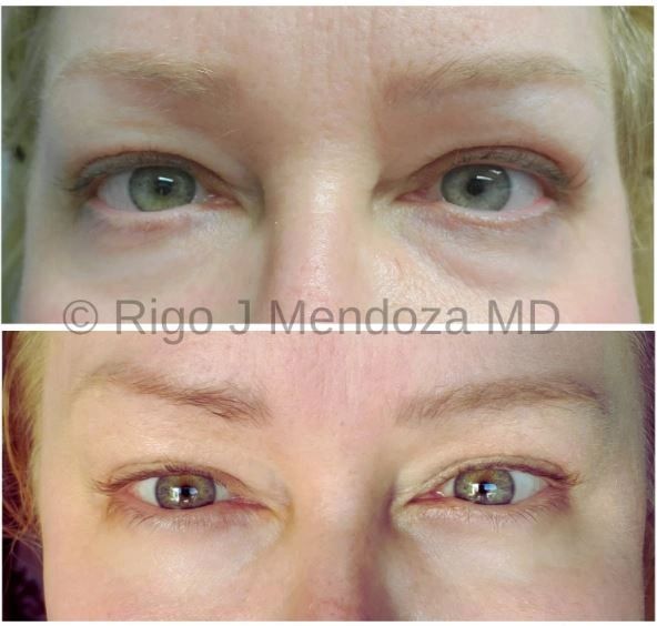 Plasma Pen of the Upper and Lower Eyelids, Crows Feet and Glabellar.