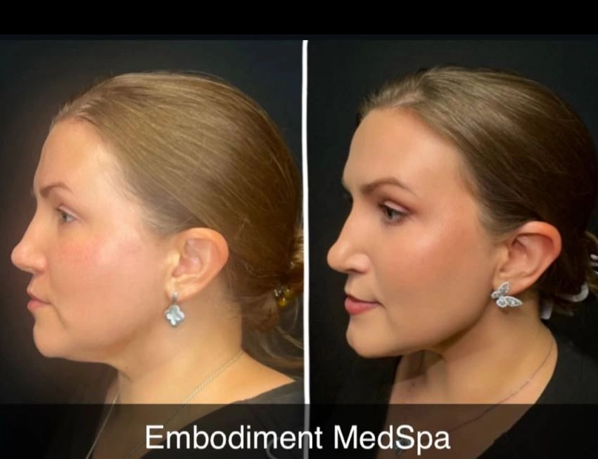 Radiesse was used to define the jawline and minimize the jowls.