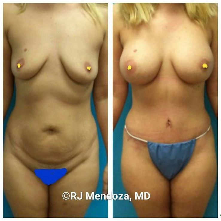 Mommy Makeover
Tummy Tuck with Muscle Repair and Breast Implants