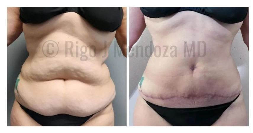 Tummy Tuck in Tampa  Abdonimoplasty in Tampa