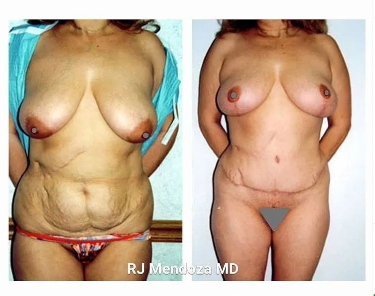 Mommy Makeover
Tummy Tuck with Muscle Repair and Breast Lift