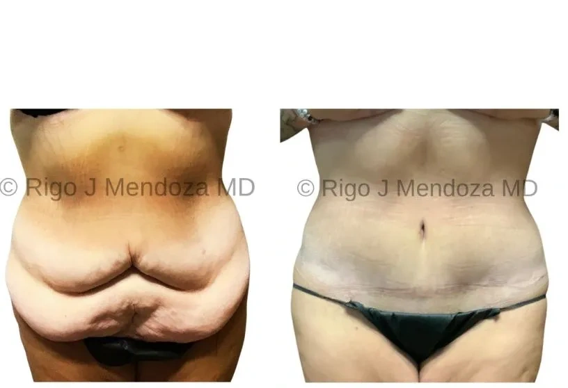 Abdominoplasty / Tummy Tuck