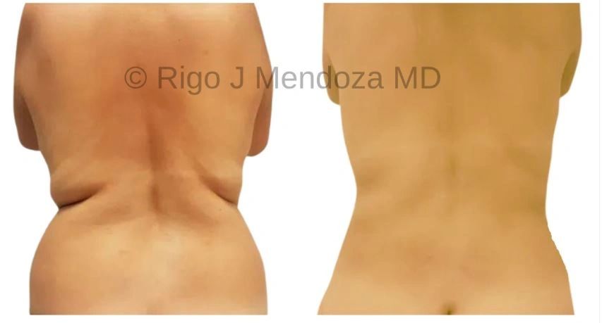 Liposuction with Renuvion J Plasma to the upper and lower back, waist and hips