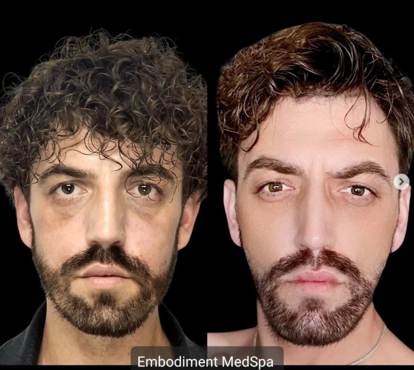 Radiesse was used to define the jawline and address the asymmetry in his chin.  Sculptra was used to