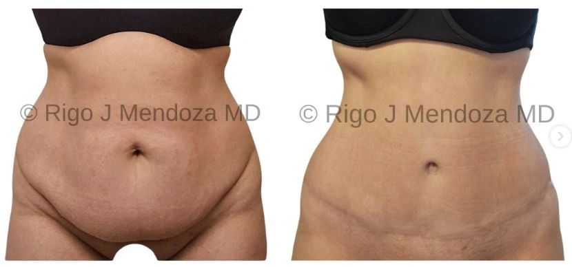 Tummy Tuck