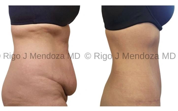 Liposuction of lower back with a tummy tuck