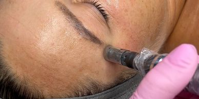 Microneedling (Collagen induction Therapy) to promote skin rejuvenation with minimal downtime.