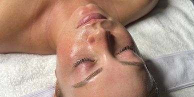Chemical Peel Facial targets fine lines, acne, scars, pigmentation. 