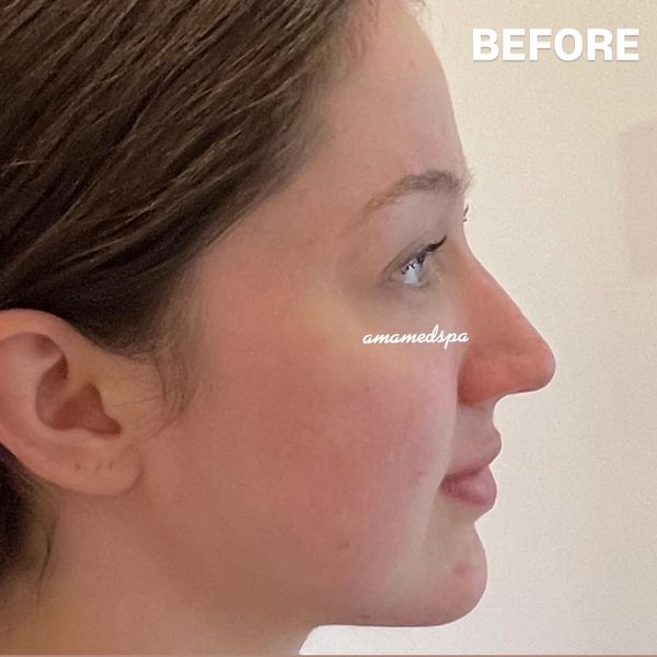 Side profile of a woman labeled 'Before' for skin treatment.