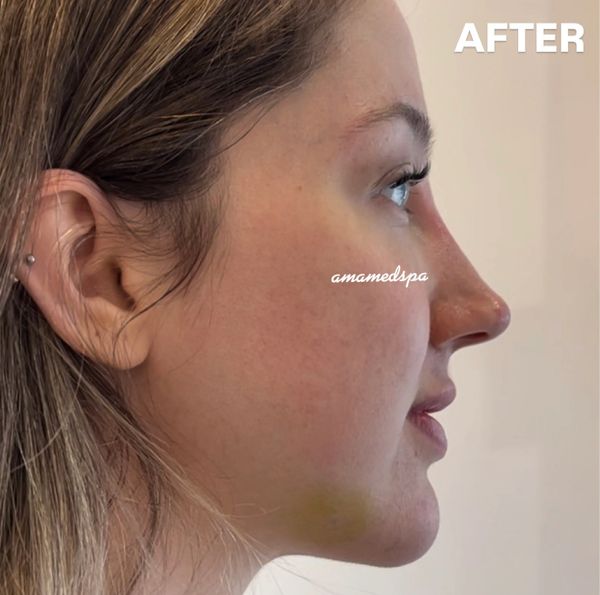 Side profile of a woman showing smooth skin after a treatment.