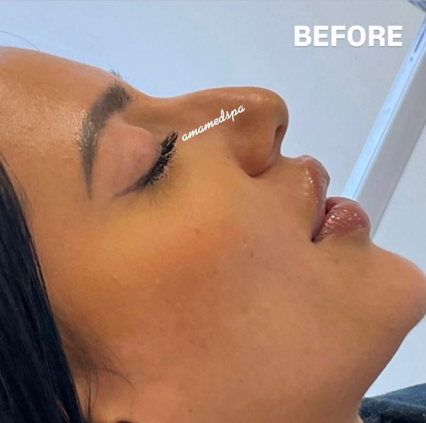 Close-up profile of a woman's face labeled 'BEFORE' treatment.