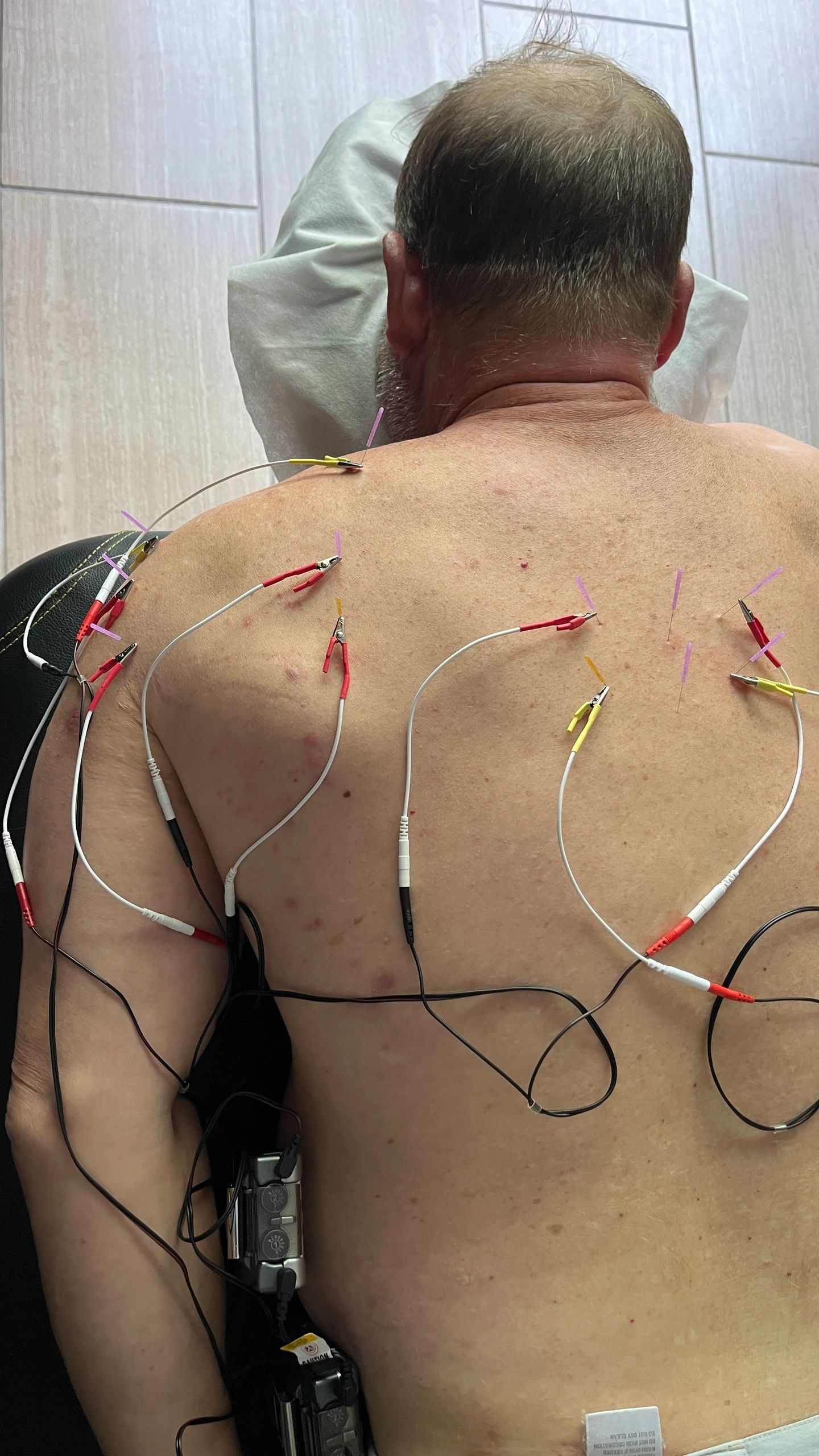 Electro Dry Needling  Al Das Medical Clinic