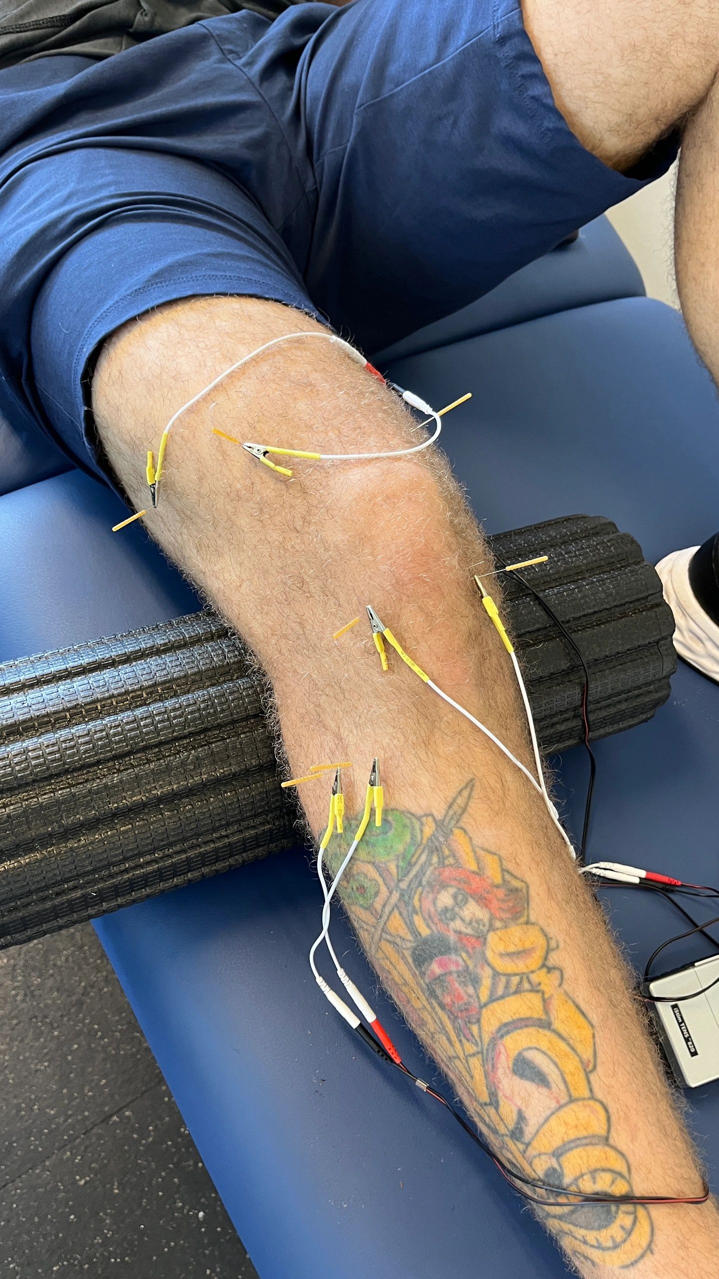 Do I Need Surgery After a Meniscal Tear?