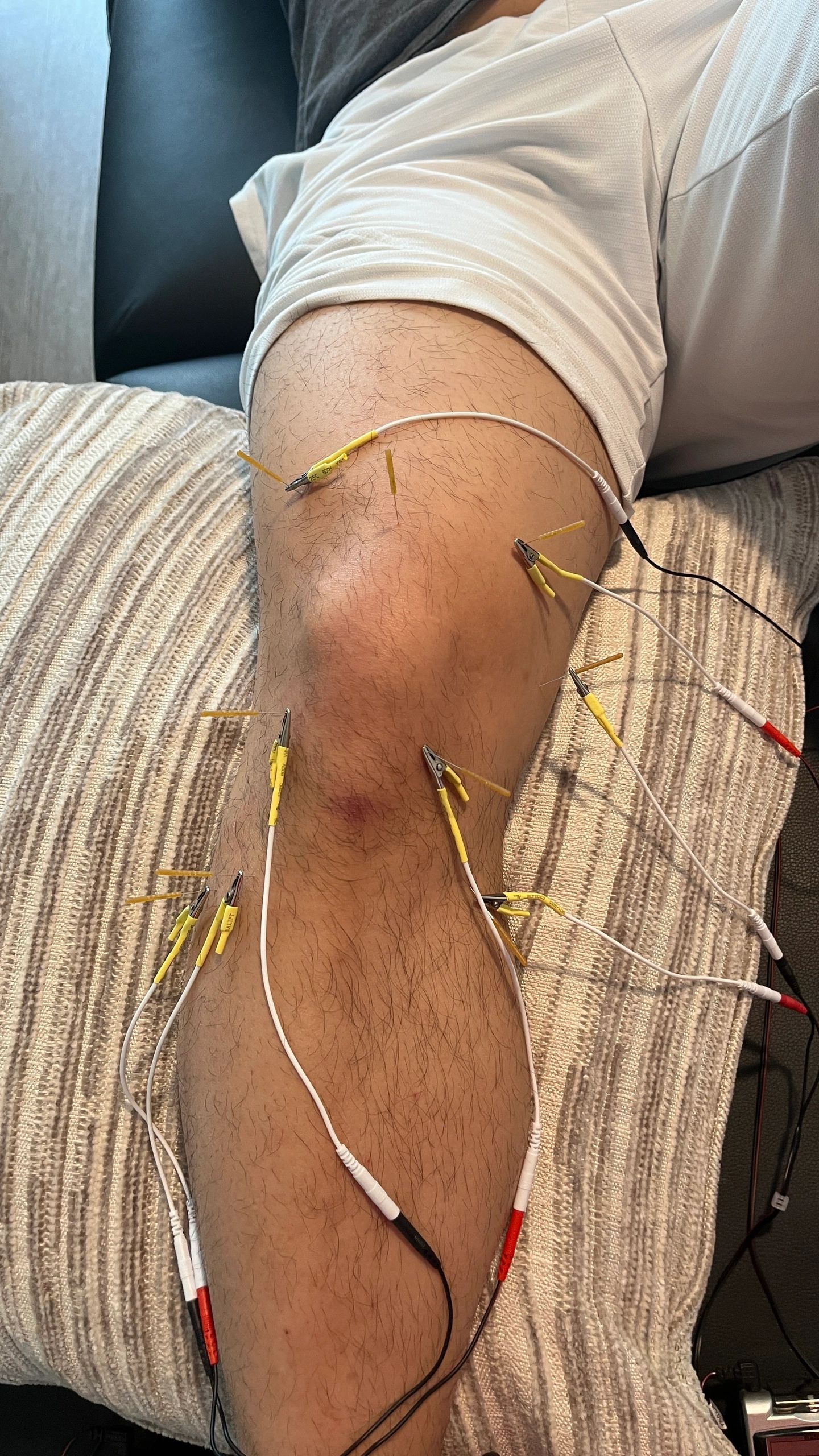 What is Electro-Dry Needling and how can it help with chronic pain and  injury treatment?