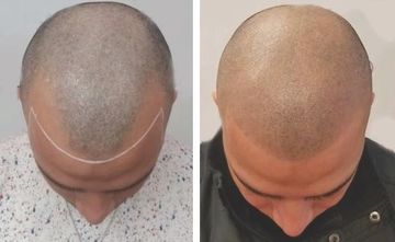 Scalp Micropigmentation - Ohio City Beauty Studio Scalp Micropigmentation - Ohio City Beauty Studio