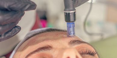 A young woman receives a microneedling treatment, also known as collagen induction therapy.