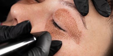 A young woman undergoes plasma skin tightening under her eyes, upper eyelid and crows feet,