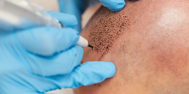Scalp Micro Pigmentation procedure, that uses micro-needles to deposit pigment into the scalp.