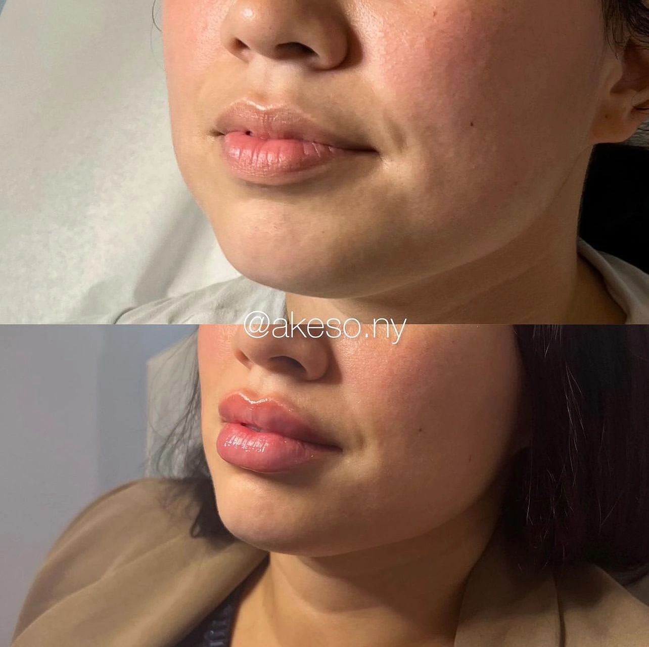 LIP AUGMENTATION 
