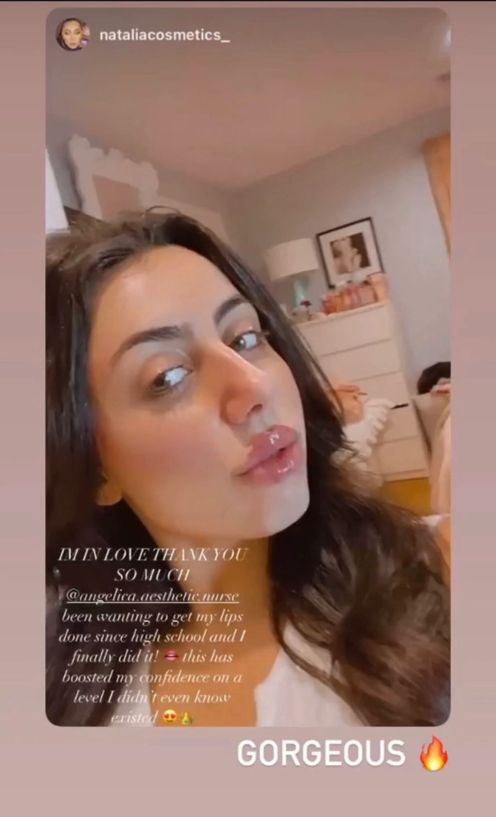 “Been wanting to get my lips done since high school and I finally did it 👄this has boosted my confi