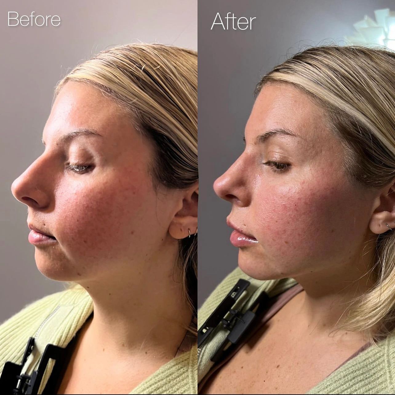 FACIAL BALANCING 