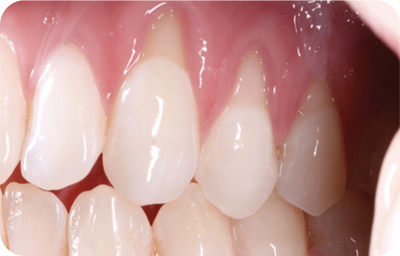 GINGIVAL TREATMENT