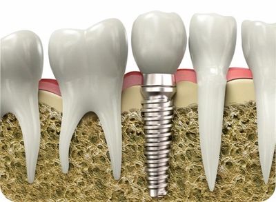 Implant