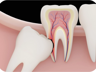 Wisdom teeth 