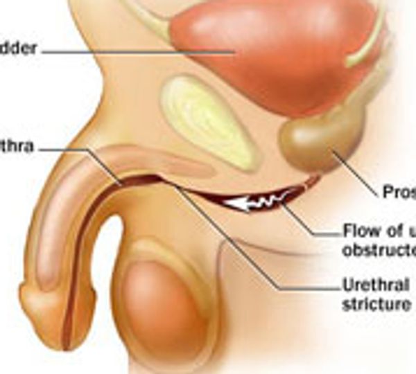 Urethral stricture Information