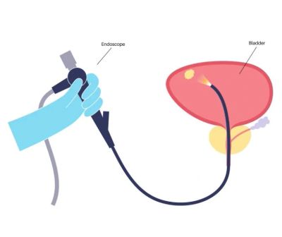 Illustration of an endoscope used to examine the bladder.