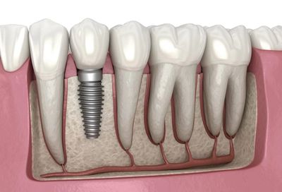 Dental Implant in Beachwood, Dentist near me.