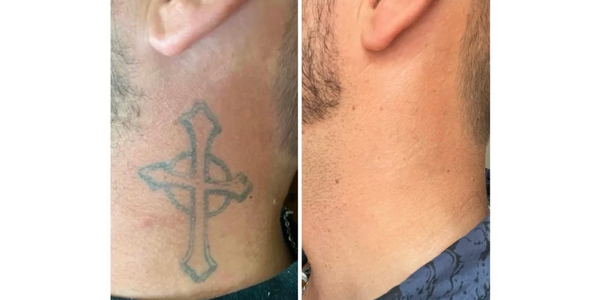 Neck Tattoo Removed
